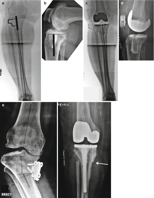 Extra-Articular Deformity | Musculoskeletal Key