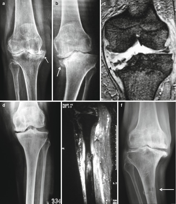 Extra-Articular Deformity | Musculoskeletal Key