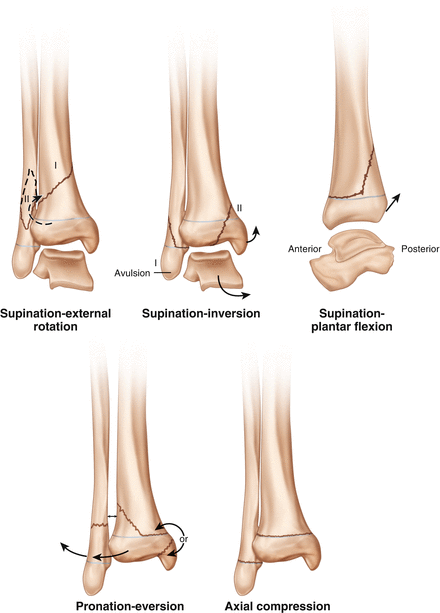 Ankle supination trauma