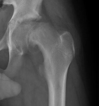 Slipped Capital Femoral Epiphysis: Acute and Chronic | Musculoskeletal Key