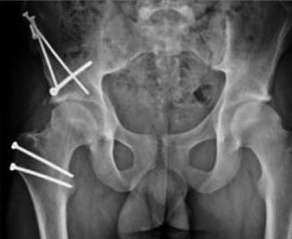 Acetabular Retroversion | Musculoskeletal Key