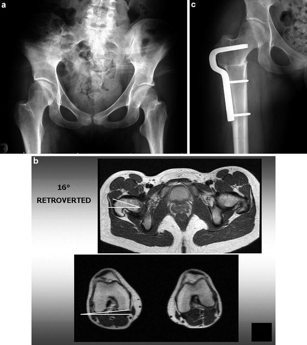 x ray femoral anteversion