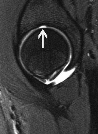 Magnetic Resonance Imaging of the Hip | Musculoskeletal Key