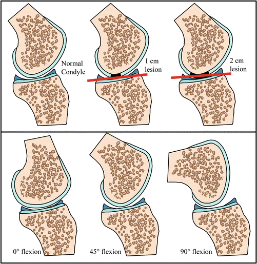 Hip Cartilage Restoration: Overview | Musculoskeletal Key