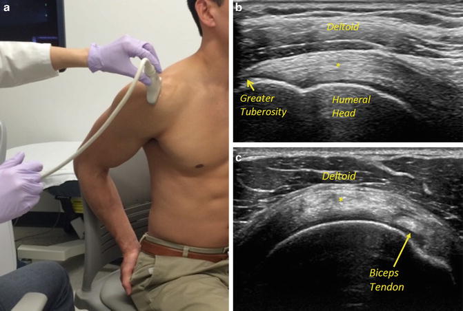 Ultrasound In Rotator Cuff Evaluation Musculoskeletal Key