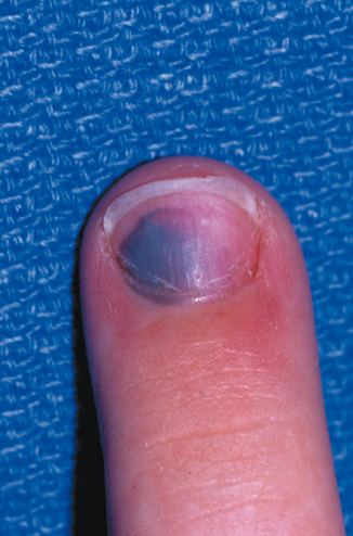 Injuries To The Nail Apparatus Musculoskeletal Key