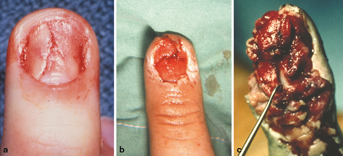 Injuries to the Nail Apparatus | Musculoskeletal Key