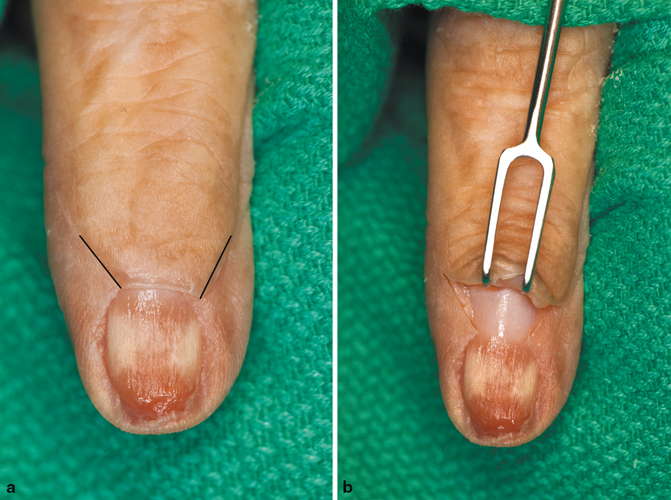 Finger Nail Plate Damage - Lunula Can Reverse Damage. - Compleet Feet