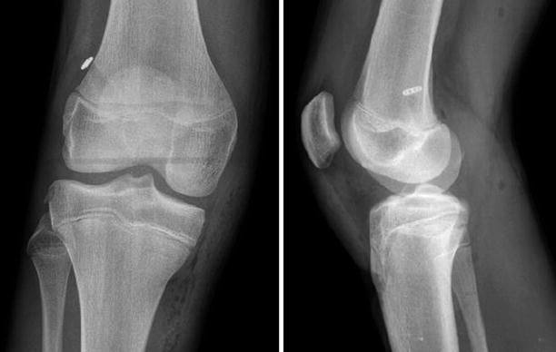 The Anterior Cruciate Ligament | Musculoskeletal Key