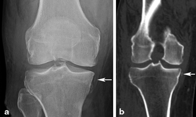 Mri Of Pcl Posteromedial And Posterolateral Corner Injuries Of The Knee Musculoskeletal Key