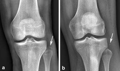 Mri Of Pcl Posteromedial And Posterolateral Corner Injuries Of The Knee Musculoskeletal Key