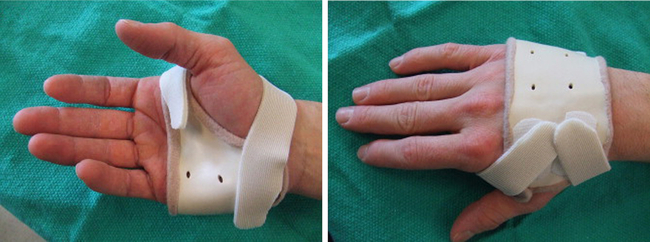 hand splint for metacarpal fracture