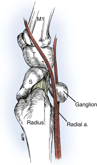 ganglion cyst diagram