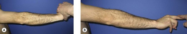 Clinical Assessment of the Elbow | Musculoskeletal Key