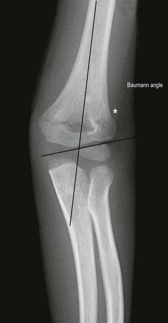 Supracondylar Fractures Of The Humerus In Children | Musculoskeletal Key