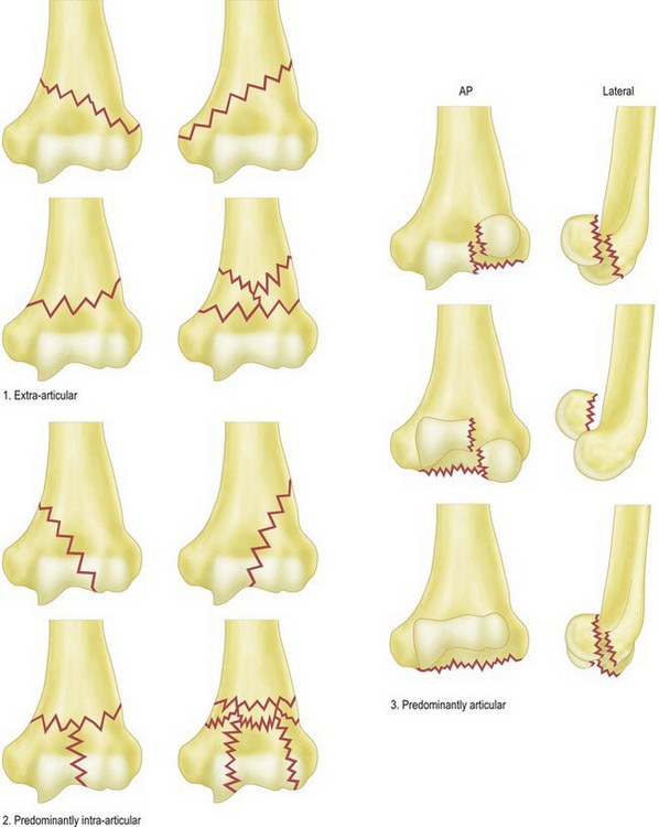 The Management Options for Adult Distal Humeral Fractures ...
