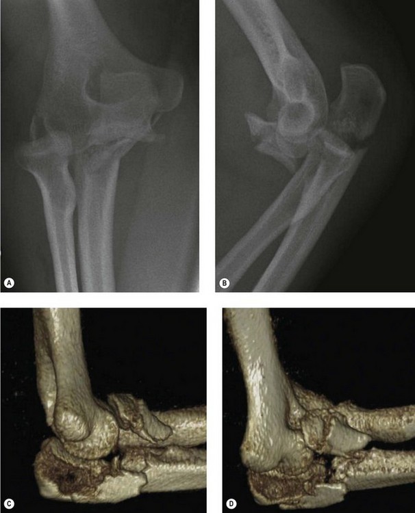 etiology of monteggia fracture
