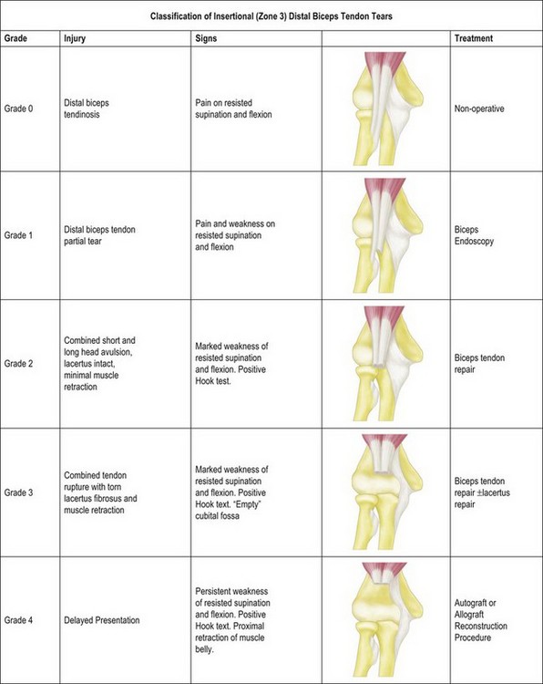 Supination Pronation Test  Distal Biceps Tendon Rupture 