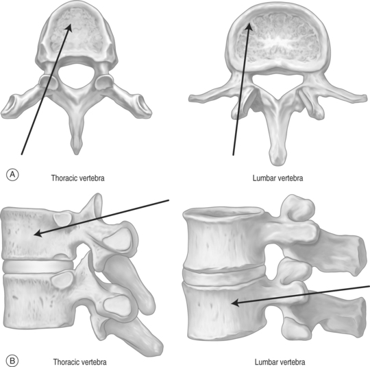 Vertebroplasty | Musculoskeletal Key