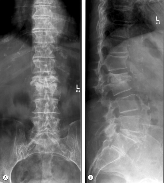 Spine Infections: An Algorithmic Approach | Musculoskeletal Key