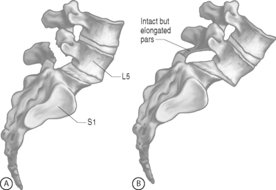 pars defect with spondylolisthesis