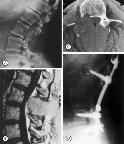 Fusion Surgery | Musculoskeletal Key