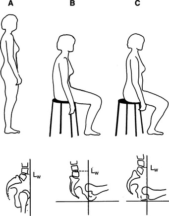 Movement Impairment Syndromes of the Lumbar Spine