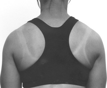 Movement Impairment Syndromes of the Shoulder Girdle | Musculoskeletal Key