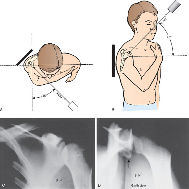 Shoulder Oblique Apical Radiographic Positioning Patient True Evaluation Pr...