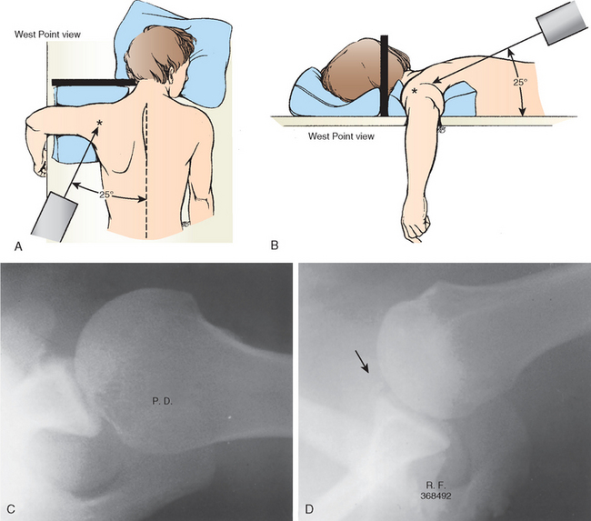 A and B, Positioning of the patient for the West Point radiograph to visual...
