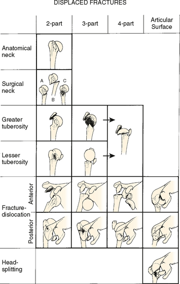 Fractures of the Proximal Humerus | Musculoskeletal Key
