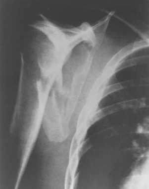 a) X-ray: comminuted fracture of the clavicle with intermediary