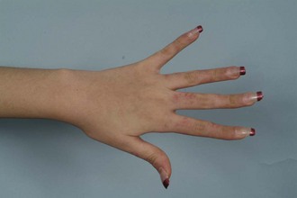 Discoid Lupus Rash On Hands