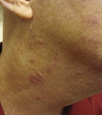 Skin Disease In Cutaneous Lupus Erythematosus Musculoskeletal Key