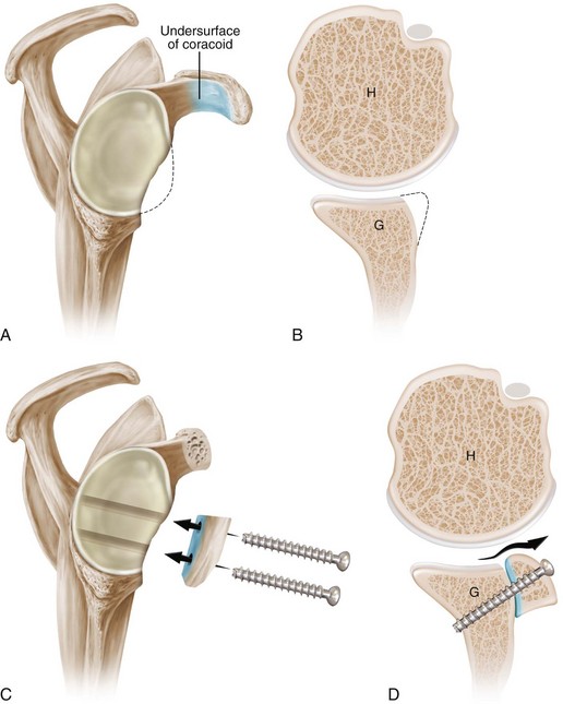 Coracoid Transfer: The Modified Latarjet Procedure for the Treatment of ...