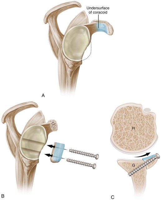 Coracoid Transfer: The Modified Latarjet Procedure for the Treatment of ...