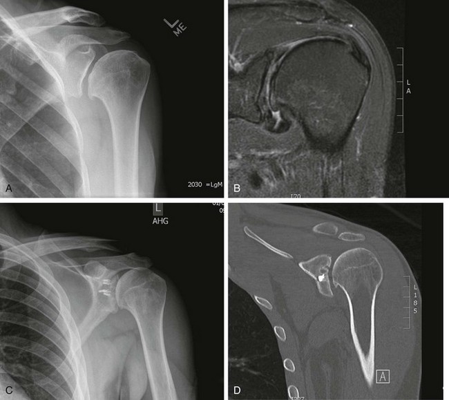 Nonarthroplasty Options for Glenohumeral Arthritis and Chondrolysis ...