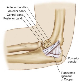 Ulnar Collateral Ligament Repair and Reconstruction | Musculoskeletal Key