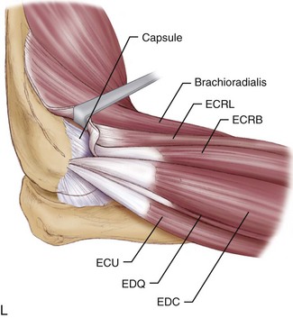 Open Elbow Contracture Release | Musculoskeletal Key
