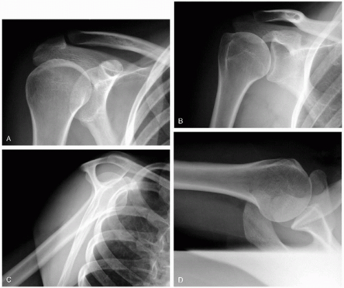 Prosthetic Replacement for Proximal Humerus Fractures | Musculoskeletal Key