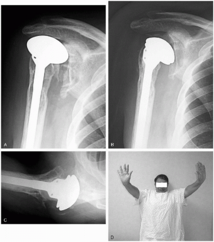 Revision Shoulder Arthroplasty | Musculoskeletal Key