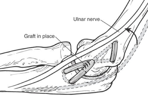Ulnar Collateral Ligament Reconstruction Procedure