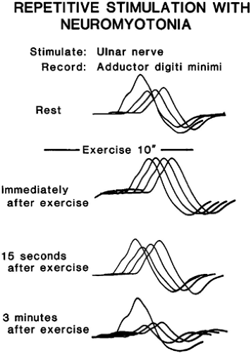 Evaluation Of The Patient With Suspected Neuromuscular Junction ...