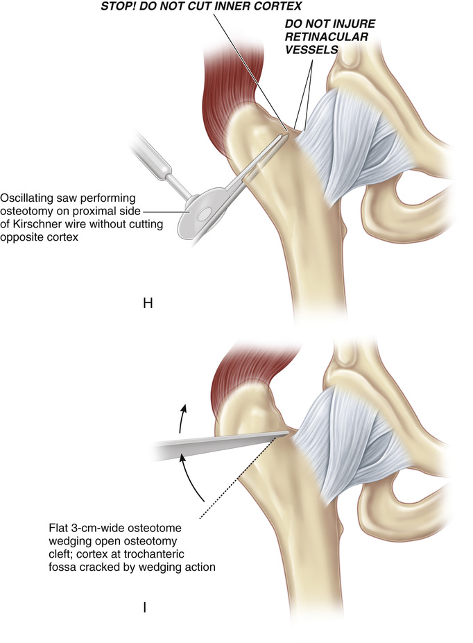 7-distal-and-lateral-transfer-of-the-greater-trochanter