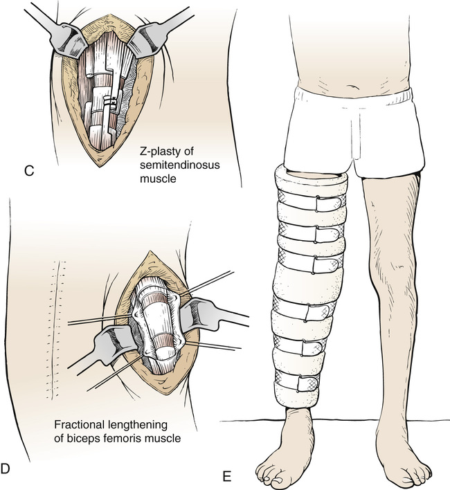 23 Hamstring Lengthening | Musculoskeletal Key