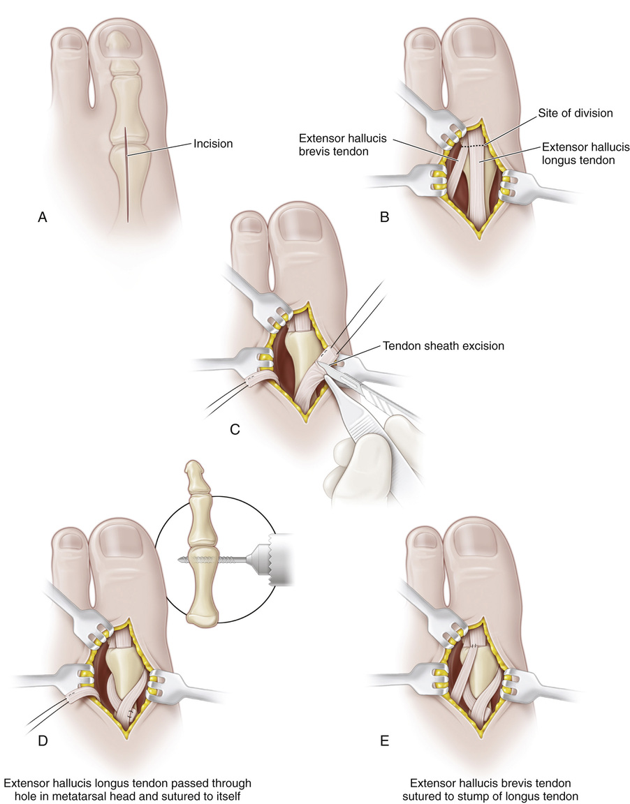 47 Transfer Of The Long Toe Extensors To The Heads Of The Metatarsals