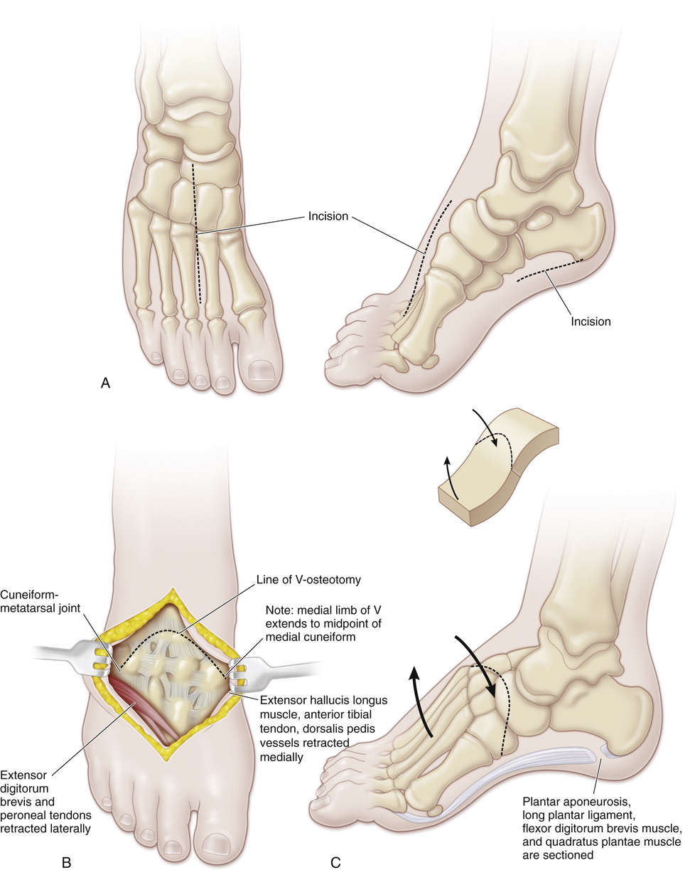 50 Japas V-Osteotomy of the Tarsus | Musculoskeletal Key