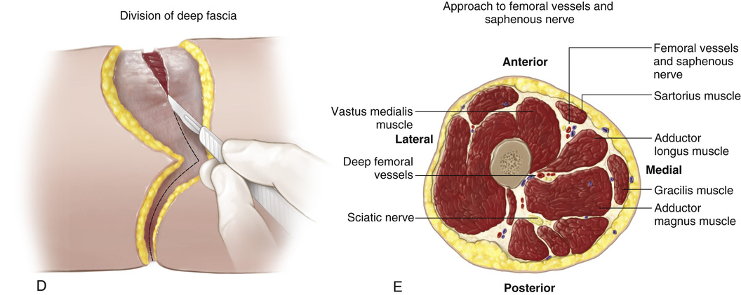 55 Ischial Bearing Above Knee Amputation Midthigh Amputation Musculoskeletal Key