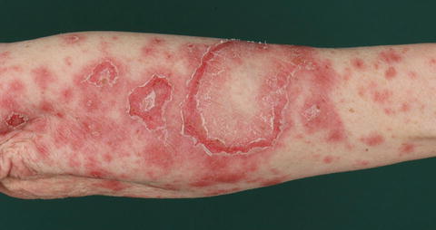 Skin Manifestations Of Systemic Lupus Erythematosus Musculoskeletal Key