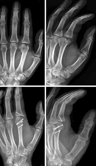 Acute Finger Injuries | Musculoskeletal Key